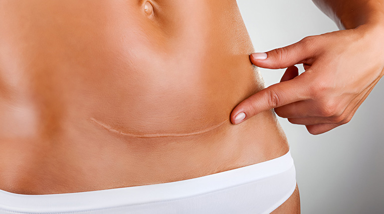 Cesarean Delivery in Mudichur